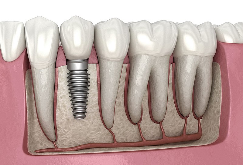 Implantes Dentales: Mitos y Verdades Explicados